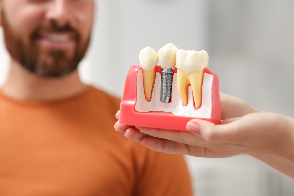 Dental Crowns in Baton Rouge, LA. Dr. Bobby Nguyen. WN Dental